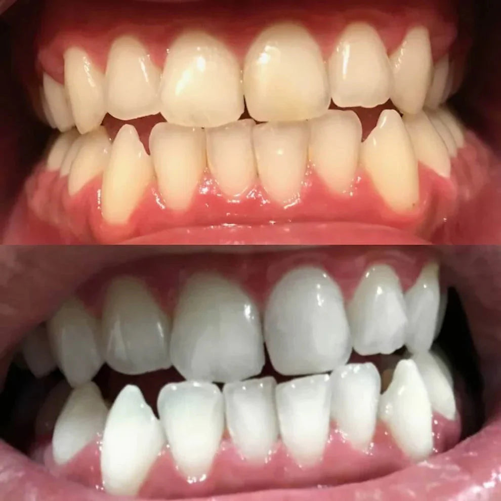 DiamondSmile™ – Zahnaufhellungsstift (1+1 GRATIS)