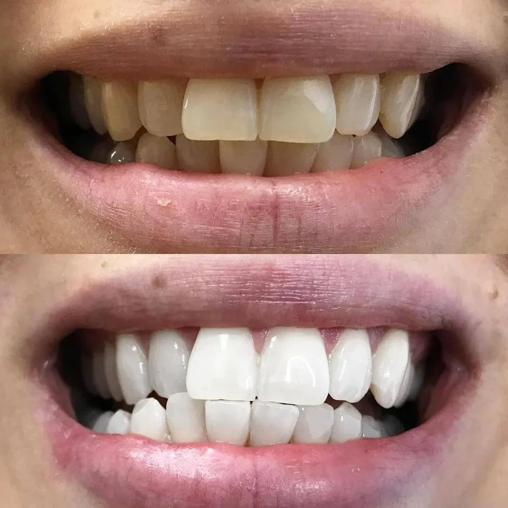 DiamondSmile™ – Zahnaufhellungsstift (1+1 GRATIS)