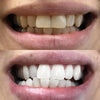 DiamondSmile™ – Zahnaufhellungsstift (1+1 GRATIS)