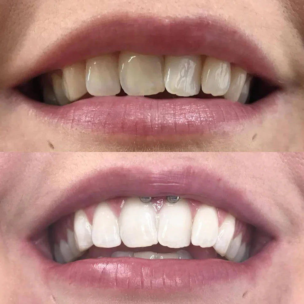DiamondSmile™ – Zahnaufhellungsstift (1+1 GRATIS)