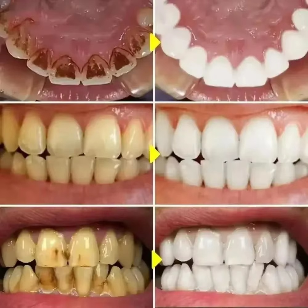 DiamondSmile™ – Zahnaufhellungsstift (1+1 GRATIS)